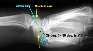 shear and lt compression test|lt interosseous injury positive test.